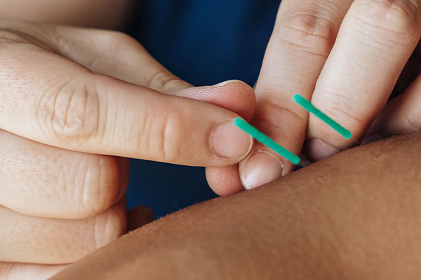 Acupuncture: Ancient Techniques for Modern Wellness