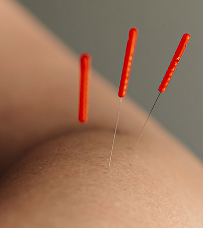 Pure Health Alliance, Image of acupuncture needles