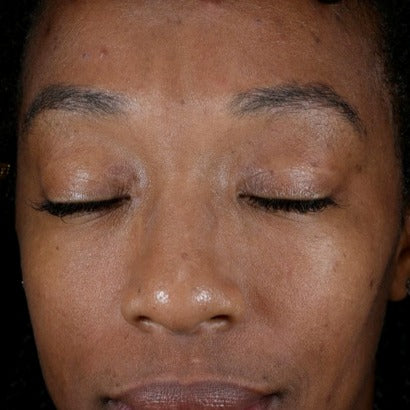 Retinol_Before