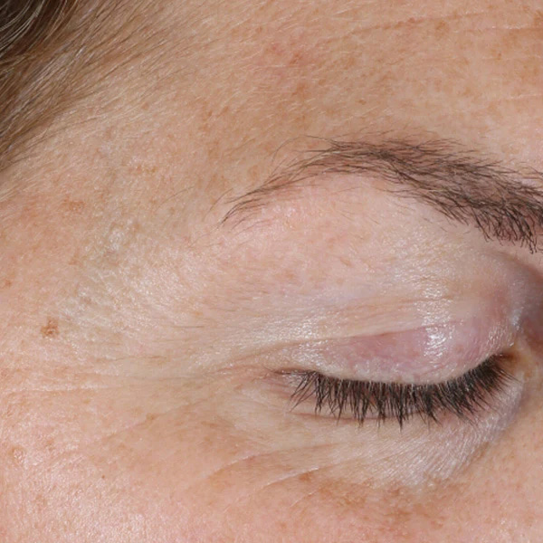 ba_retinol_2_before